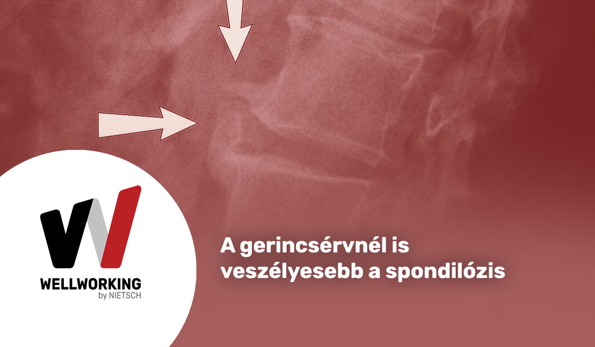 A gerincsérvnél is veszélyesebb a spondilózis